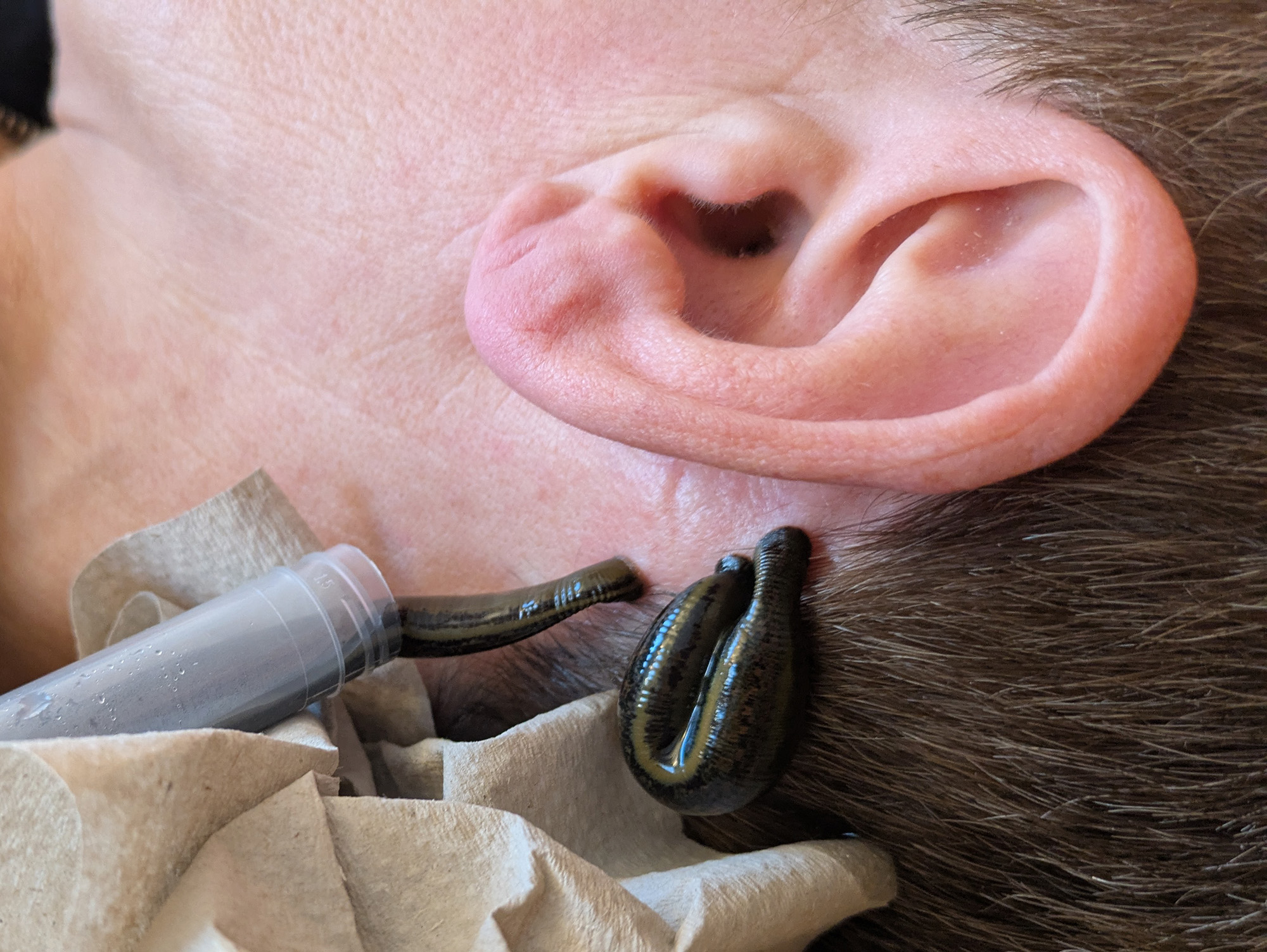 Gesundheitspraxis Yvonne Geistert Leistungsbeschreibung Blutegeltherapie / Blutegelbehandlung